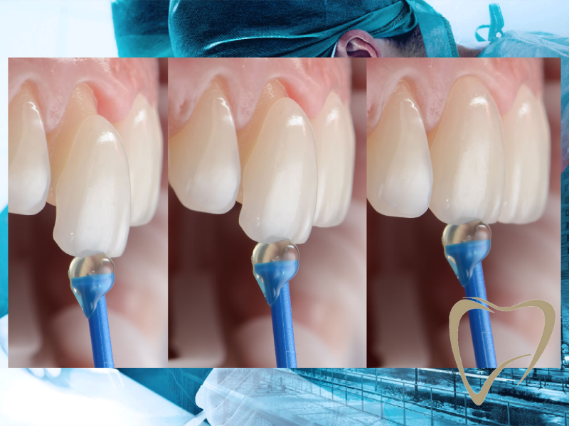 What Is Laminate Veneer Treatment?