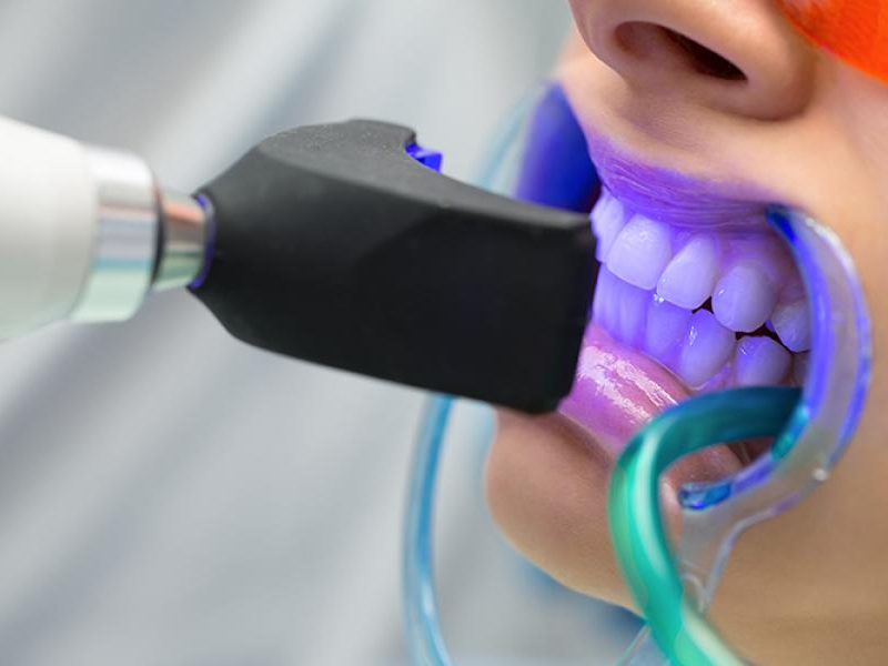 What Is Teeth Whitening (Bleaching)? | Brighter Smile Guide
