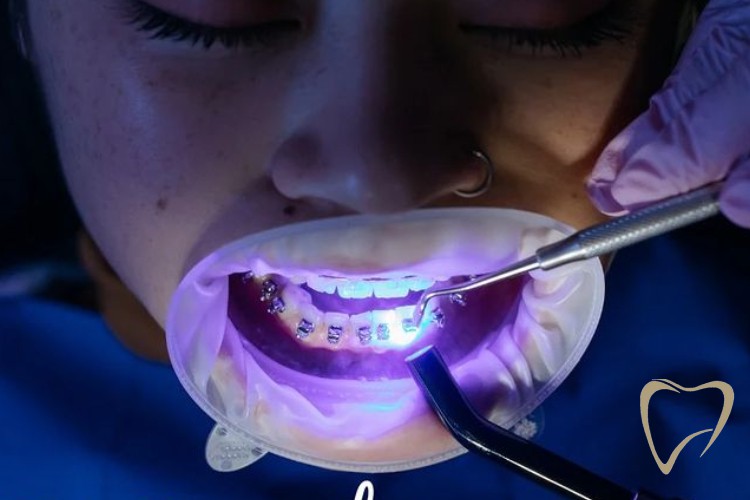Traitement Orthodontique