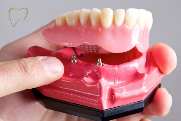 Prothèses Fixes Sur Implants