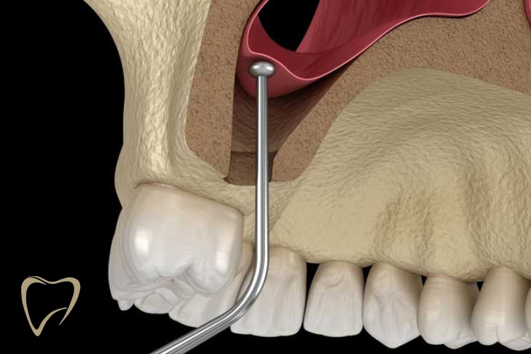 Chirurgie de Sinus Lift