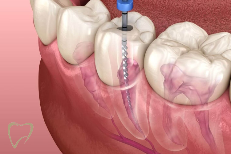Traitements Endodontiques