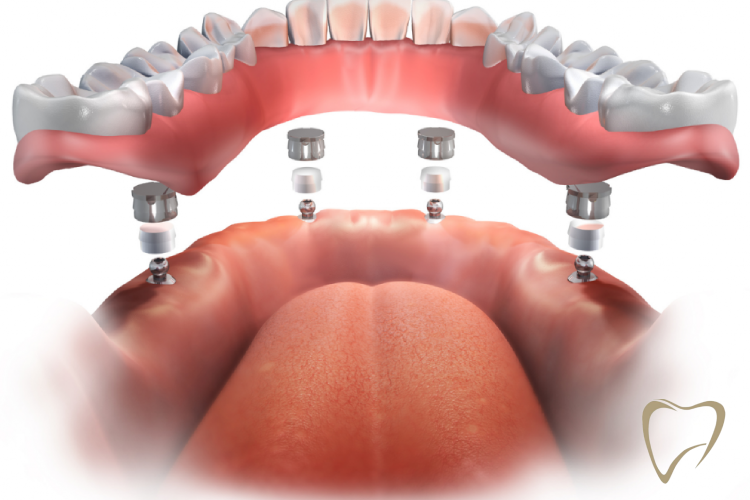Prothèses Amovibles Sur Implants