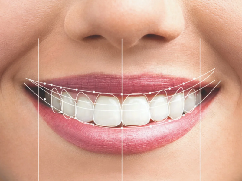 Gülüş Tasarımı (Hollywood Smile)